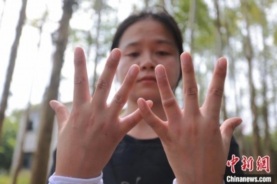 吳素英展示被蜜蜂蜇過的雙手。湯曉逵 攝