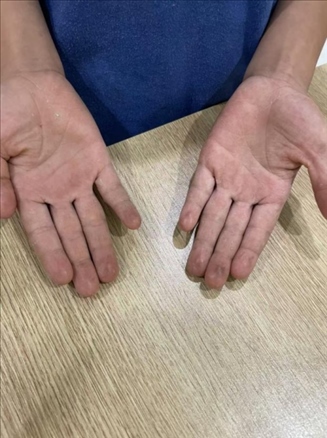 9歲小學(xué)生長(zhǎng)期拍煙卡，手部粗糙長(zhǎng)繭。受訪者供圖